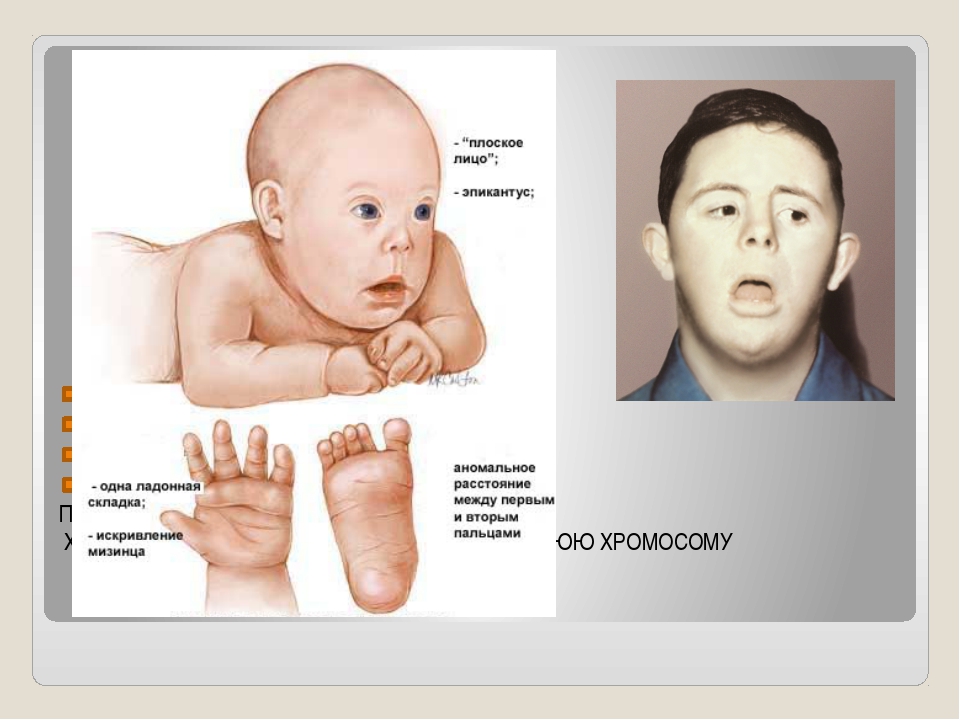 Синдром дауна признаки фото